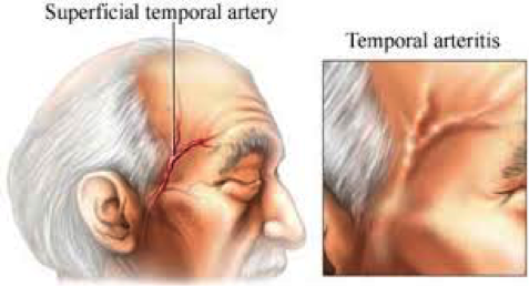 Arterite temporal – uma emergência em geriatria