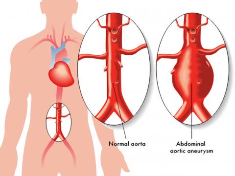 O Check-up no idoso e o aneurisma da aorta abdominal